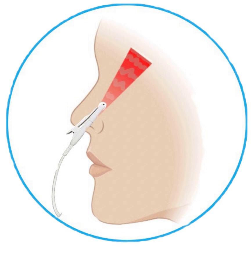 Animatie van rood licht therapie laserlicht in neus
